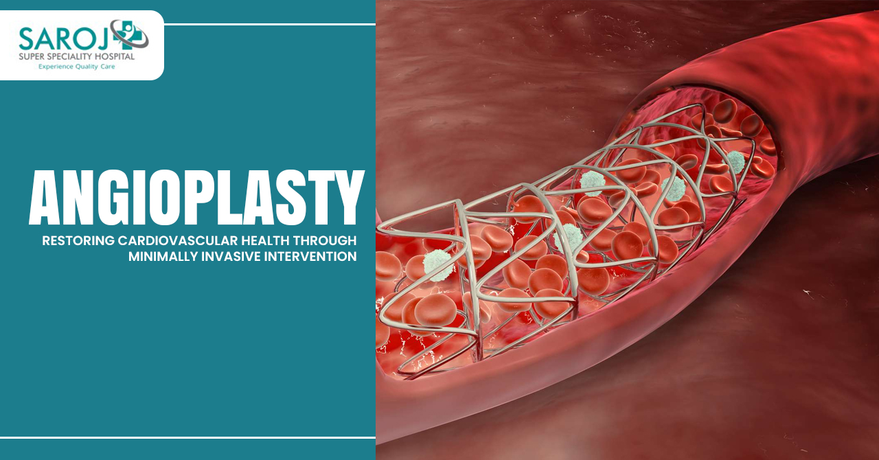 Angioplasty - Preparation Procedure Benefits And Recovery_528_Angioplasty.jpg